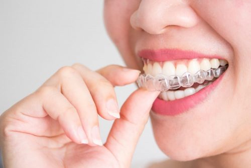 How Does Invisalign Treatment Work?