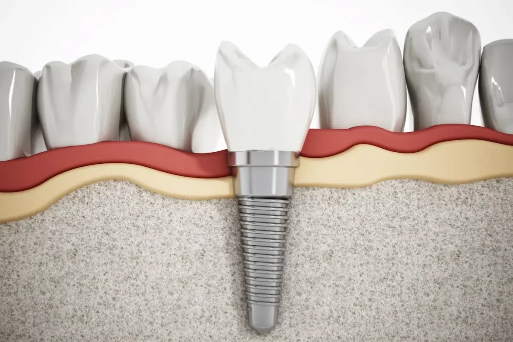 Custom Dental Implants Banner 1