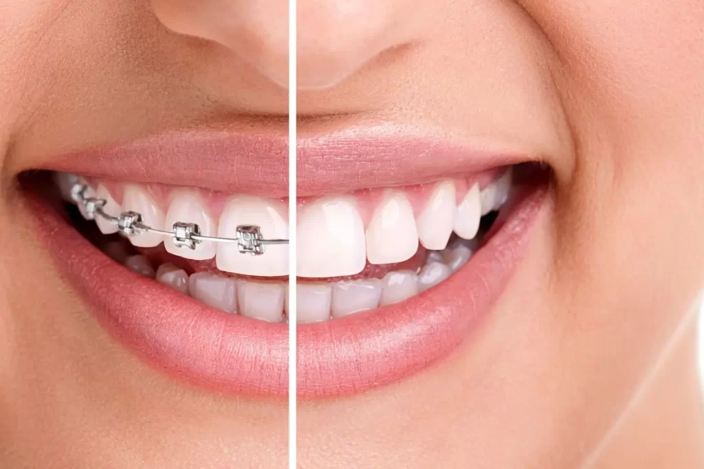 Invisalign Over Traditional Braces