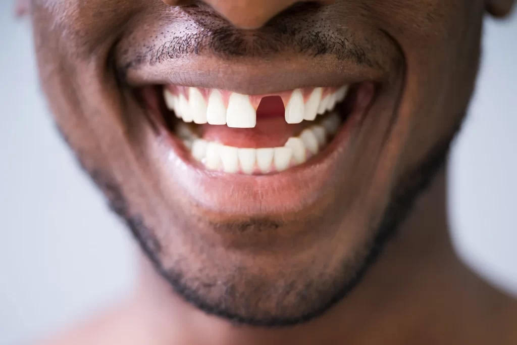 Knocked Out Tooth Emergency